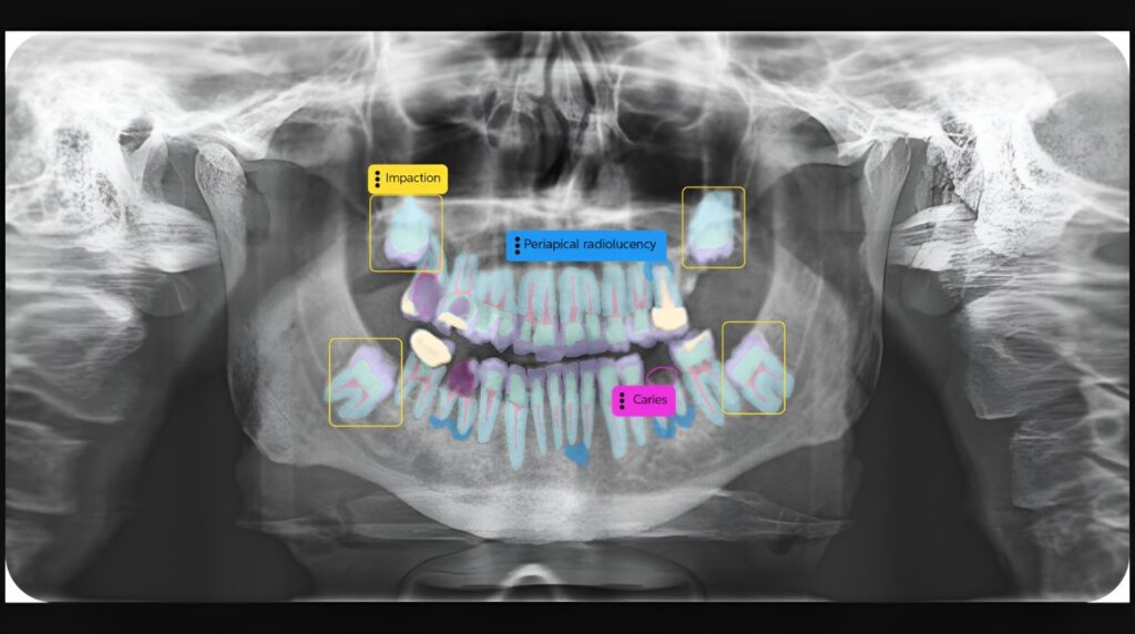 Pearl AI radiograph viewer with AI-generated pathology annotations, confidence scores and color-coded severity indicators